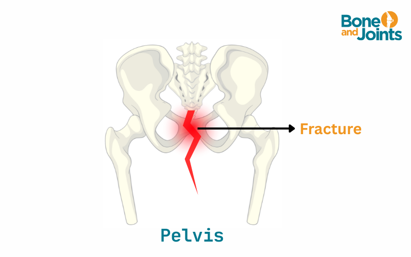 Pelvic bone fracture.png