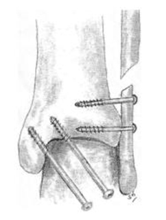 Ankle fusion surgery