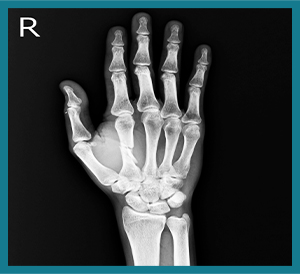 X-ray of hand