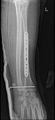 post operation x ray